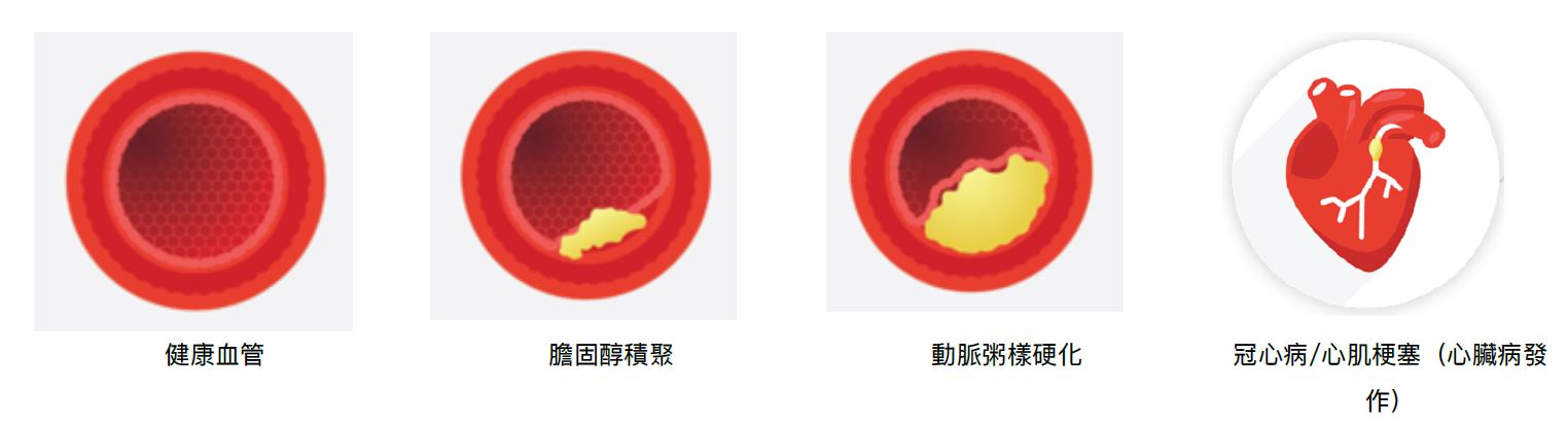 圖表⼀ - 由⾼膽固醇引致的⼼臟病演變過程
